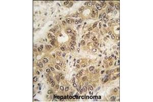 Formalin-fixed and paraffin-embedded human hepatocarcinoma tissue reacted with ZIC3 antibody (N-term) (ABIN389243 and ABIN2839388) , which was peroxidase-conjugated to the secondary antibody, followed by DAB staining. (ZIC3 抗体  (N-Term))