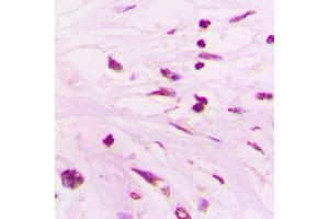 Immunohistochemical analysis of SUPT3H staining in human lung cancer formalin fixed paraffin embedded tissue section.
