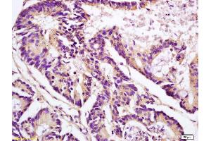 Formalin-fixed and paraffin embedded human colon carcinoma labeled with Anti-APOJ/Clusterin Polyclonal Antibody, Unconjugated (ABIN685342) at 1:200 followed by conjugation to the secondary antibody and DAB staining (Clusterin 抗体  (AA 331-449))