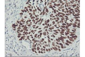Immunohistochemical staining of paraffin-embedded Carcinoma of Human lung tissue using anti-TP53 mouse monoclonal antibody. (p53 抗体)
