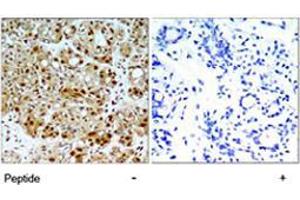 Immunohistochemical analysis of paraffin-embedded human breast carcinoma tissue using HSP90AB1 polyclonal antibody  . (HSP90AB1 抗体)