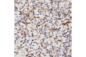 Immunohistochemistry of paraffin-embedded human kidney cancer tissue using CA4 antibody at dilution of 1:200 (x400 lens) (CA4 抗体)