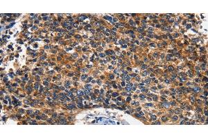 Immunohistochemistry of paraffin-embedded Human lung cancer using HK2 Polyclonal Antibody at dilution of 1:60 (Hexokinase 2 抗体)