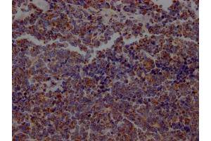IHC image of ABIN7127319 diluted at 1:100 and staining in paraffin-embedded human lung cancer performed on a Leica BondTM system. (Recombinant ACO2 抗体)