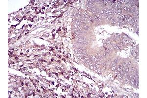 Immunohistochemical analysis of paraffin-embedded rectum cancer tissues using CD6 mouse mAb with DAB staining. (CD6 抗体  (AA 18-199))