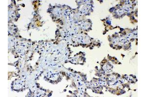 IHC analysis of ETV6/Tel using anti-ETV6/Tel antibody . (ETV6 抗体  (AA 327-448))