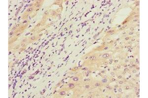 Immunohistochemistry of paraffin-embedded human liver cancer using ABIN7172660 at dilution of 1:100 (GTF2A2 抗体  (AA 1-109))