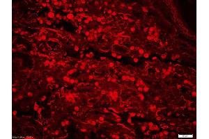 Formalin-fixed and paraffin-embedded human lung cancer labeled with Rabbit Anti-ERK5 (Ser731+Thr733) Polyclonal Antibody, Unconjugatedused at 1:200 dilution for 40 minutes at 37°C. (MAPK7 抗体  (pSer731, pThr733))