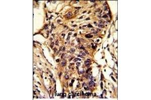 Formalin-fixed and paraffin-embedded human lung carcinoma reacted with BCKDHA Antibody (C-term), which was peroxidase-conjugated to the secondary antibody, followed by DAB staining. (BCKDHA 抗体  (C-Term))