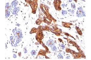 Formalin-fixed, paraffin-embedded human breast carcinoma stained with EMA antibody (MUC1/845). (MUC1 抗体)