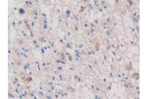 Detection of PALB in Human Glioma Tissue using Polyclonal Antibody to Prealbumin (PALB) (TTR 抗体  (AA 21-147))
