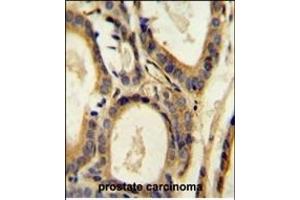 CCL4 Antibody (Center) (ABIN654131 and ABIN2850474) immunohistochemistry analysis in formalin fixed and paraffin embedded human prostate carcinoma followed by peroxidase conjugation of the secondary antibody and DAB staining. (CCL4 抗体  (AA 22-48))