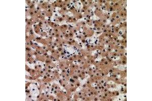 Immunohistochemical analysis of TIP60 staining in human liver cancer formalin fixed paraffin embedded tissue section. (KAT5 抗体)