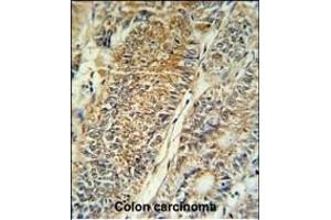 PYCR1 Antibody (C-term) (ABIN653849 and ABIN2843112) IHC analysis in formalin fixed and paraffin embedded colon carcinoma followed by peroxidase conjugation of the secondary antibody and DAB staining. (PYCR1 抗体  (C-Term))