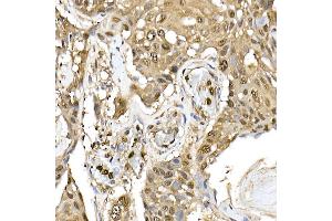 Immunohistochemistry of paraffin-embedded human esophageal cancer using ERK1/2 Rabbit mAb (ABIN7268620) at dilution of 1:100 (40x lens). (ERK1 抗体)