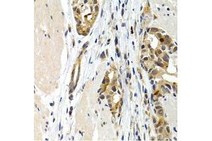 Immunohistochemistry of paraffin-embedded human stomach cancer using IL9 antibody (ABIN3015677, ABIN3015678, ABIN1680463 and ABIN6219030) at dilution of 1:200 (40x lens). (IL-9 抗体  (AA 19-144))