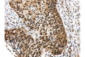 The image on the left is immunohistochemistry of paraffin-embedded Human esophagus cancer tissue using ABIN7192767(TEX37 Antibody) at dilution 1/40, on the right is treated with synthetic peptide. (TEX37 抗体)