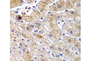 Immunohistochemistry of paraffin-embedded Human liver damage using DPP3 Polyclonal Antibody at dilution of 1:100 (40x lens). (DPP3 抗体)
