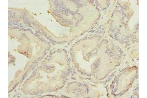 Immunohistochemistry of paraffin-embedded human prostate cancer using ABIN7159116 at dilution of 1:100 (MED18 抗体  (AA 35-208))