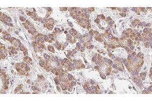 ABIN6279174 at 1/100 staining Human liver cancer tissue by IHC-P. (KCNJ10 抗体  (Internal Region))