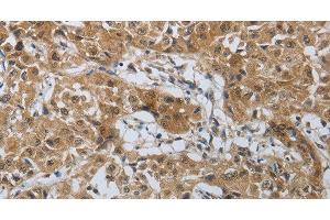 Immunohistochemistry of paraffin-embedded Human lung cancer tissue using PTPRM Polyclonal Antibody at dilution 1:40 (PTPRM 抗体)