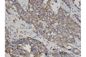 Immunoperoxidase of monoclonal antibody to LGALS4 on formalin-fixed paraffin-embedded human ovarian cancer. (GAL4 抗体  (AA 51-150))