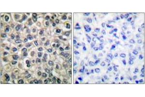 Immunohistochemistry analysis of paraffin-embedded human breast carcinoma tissue, using Catenin-gamma Antibody. (JUP 抗体  (AA 696-745))