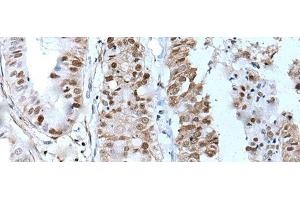 Immunohistochemistry of paraffin-embedded Human liver cancer tissue using ZNHIT3 Polyclonal Antibody at dilution of 1:80(x200) (ZNHIT3 抗体)
