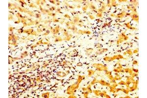 IHC image of ABIN7171412 diluted at 1:800 and staining in paraffin-embedded human liver cancer performed on a Leica BondTM system. (TCP1 alpha/CCTA 抗体  (AA 406-506))