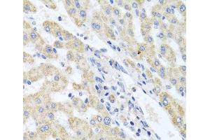 Immunohistochemistry of paraffin-embedded Human liver damage using ITPKB Polyclonal Antibody at dilution of 1:100 (40x lens). (ITPKB 抗体)