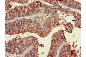 Immunohistochemistry of paraffin-embedded human endometrial cancer using ABIN7173463 at dilution of 1:100 (TRIM54 抗体  (AA 60-358))
