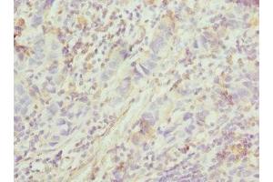 Immunohistochemistry of paraffin-embedded human bladder cancer using ABIN7153264 at dilution of 1:100 (FGD5 抗体  (AA 1203-1462))