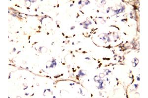 Anti-IFITM1 antibody, IHC(P) IHC(P): Human Intestinal Cancer Tissue (IFITM1 抗体  (N-Term))
