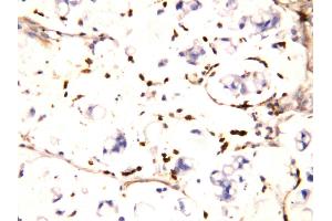 Anti-IFITM1 antibody, IHC(P) IHC(P): Human Intestinal Cancer Tissue