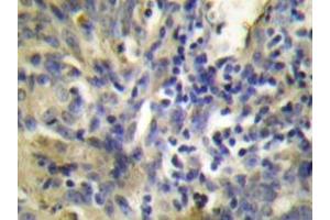 Immunohistochemistry analyzes of Cystatin A antibody in paraffin-embedded human lung carcinoma tissue. (CSTA 抗体)