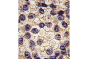Formalin-fixed and paraffin-embedded human prostata carcinoma tissue reacted with PDGFRA Antibody  f , which was peroxidase-conjugated to the secondary antibody, followed by DAB staining. (PDGFRA 抗体  (AA 740-769))