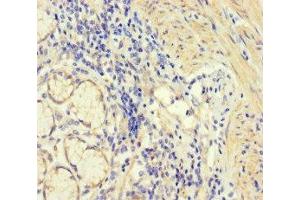 Immunohistochemistry of paraffin-embedded human gastric cancer using ABIN7148597 at dilution of 1:100 (CORO1B 抗体  (AA 252-453))