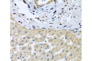 Immunohistochemistry of paraffin-embedded Human liver damage using LETMD1 Polyclonal Antibody at dilution of 1:100 (40x lens). (LETMD1 抗体)
