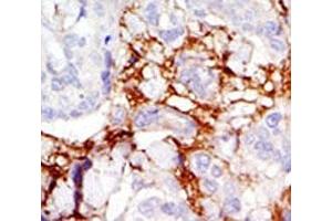 IHC analysis of FFPE human breast carcinoma tissue stained with the PAK3 antibody (PAK3 抗体  (AA 218-247))