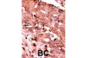 Formalin-fixed and paraffin-embedded human cancer tissue reacted with the primary antibody, which was peroxidase-conjugated to the secondary antibody, followed by AEC staining. (Caspase 6 抗体  (pSer257))