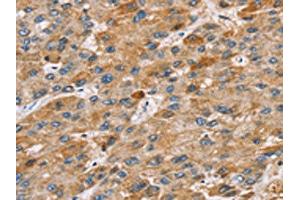 The image on the left is immunohistochemistry of paraffin-embedded Human liver cancer tissue using ABIN7131211(STARD8 Antibody) at dilution 1/30, on the right is treated with fusion protein. (STARD8 抗体)