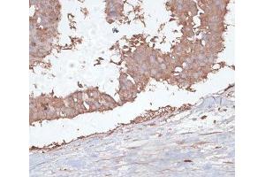 Immunohistochemistry of paraffin-embedded Human mammary cancer using TGFBR2 Polyclonal Antibody at dilution of 1:100 (40x lens). (TGFBR2 抗体)
