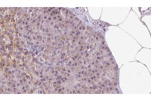 ABIN6273293 at 1/100 staining Human pancreas cancer tissue by IHC-P. (PDIA6 抗体  (C-Term))