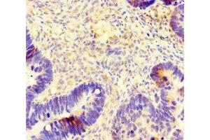 Immunohistochemistry of paraffin-embedded human ovarian cancer using ABIN7173691 at dilution of 1:100 (TUBB4 抗体  (AA 1-444))