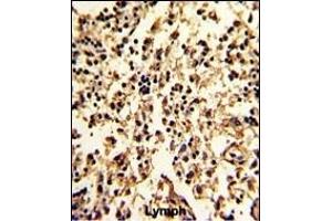 Formalin-fixed and paraffin-embedded human lymph with SERPINA9 Antibody (Center), which was peroxidase-conjugated to the secondary antibody, followed by DAB staining. (SERPINA9 抗体  (AA 194-222))