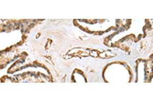 Immunohistochemistry of paraffin-embedded Human thyroid cancer tissue using SFN Polyclonal Antibody at dilution of 1:25(x200) (14-3-3 sigma/SFN 抗体)