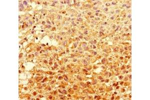 Immunohistochemistry of paraffin-embedded human melanoma using ABIN7154056 at dilution of 1:100 (GCDH 抗体  (AA 45-300))