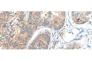Immunohistochemistry of paraffin-embedded Human gastric cancer tissue using BCAN Polyclonal Antibody at dilution of 1:35(x200) (BCAN 抗体)