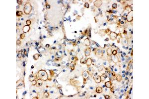 Anti-Integrin alpha 1 antibody,  IHC(P) IHC(P): Human Lung Cancer Tissue (Integrin alpha 1 抗体  (C-Term))