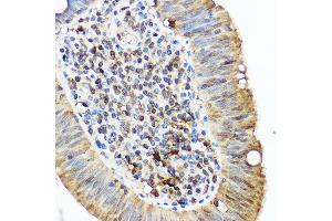 Immunohistochemistry of paraffin-embedded human lung cancer using /IB Rabbit pAb (2391) at dilution of 1:50 (40x lens). (Iba1 抗体  (AA 1-147))